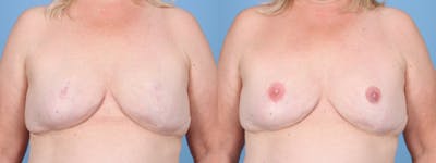 3D Nipple Tattoo Before & After Gallery - Patient 384656 - Image 1