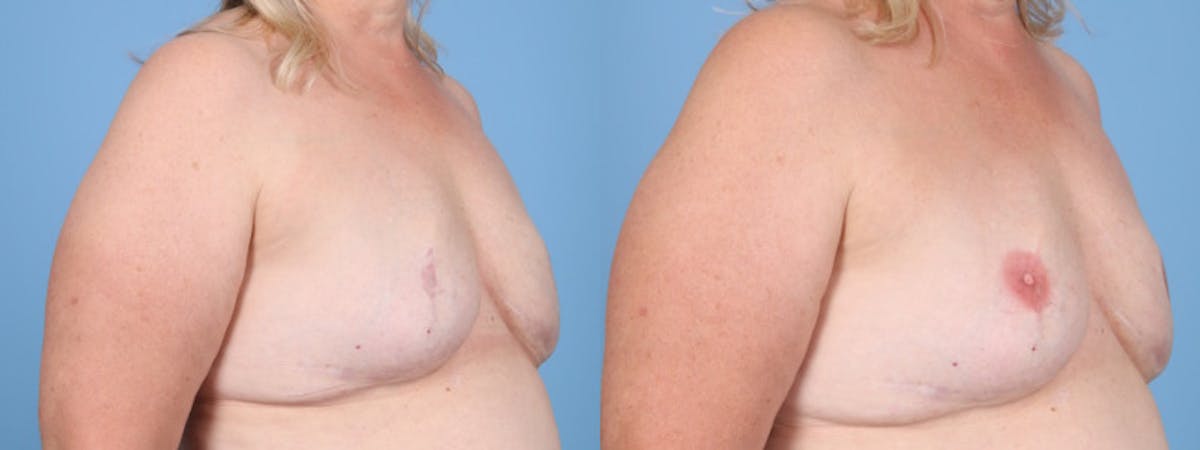 3D Nipple Tattoo Before & After Gallery - Patient 384656 - Image 2