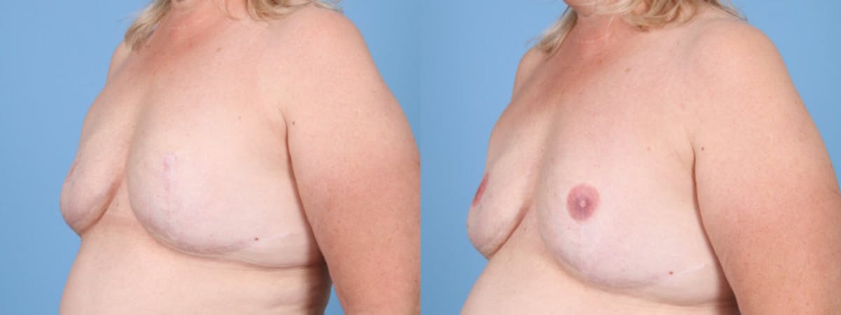 3D Nipple Tattoo Before & After Gallery - Patient 384656 - Image 3