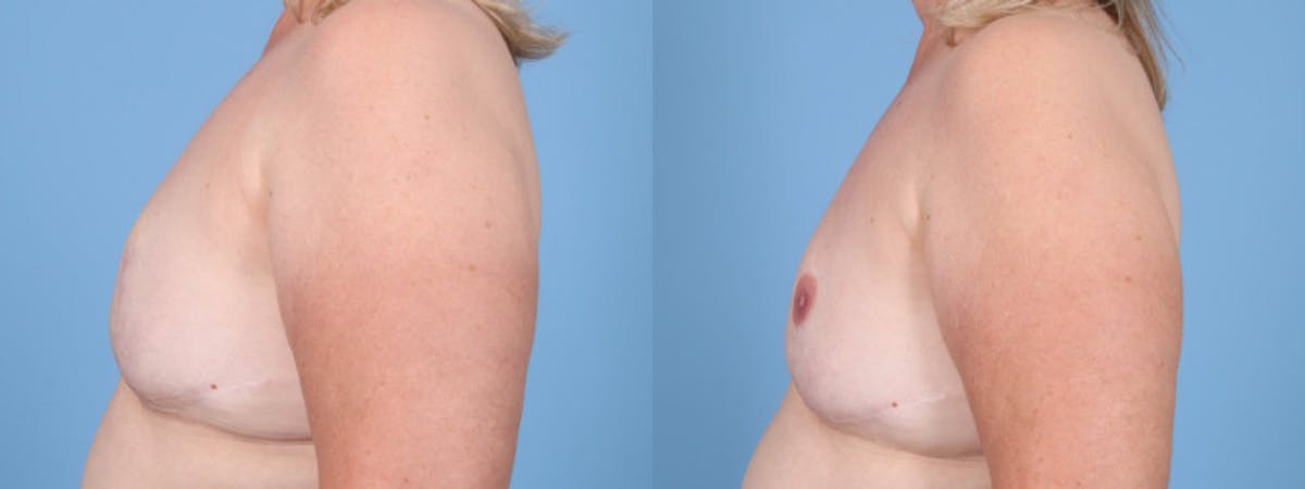3D Nipple Tattoo Before & After Gallery - Patient 384656 - Image 4