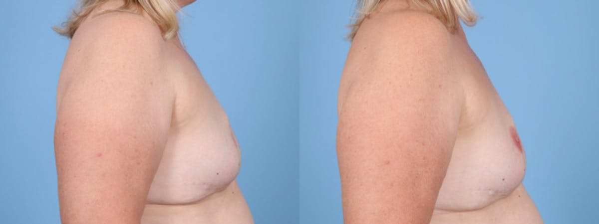3D Nipple Tattoo Before & After Gallery - Patient 384656 - Image 5