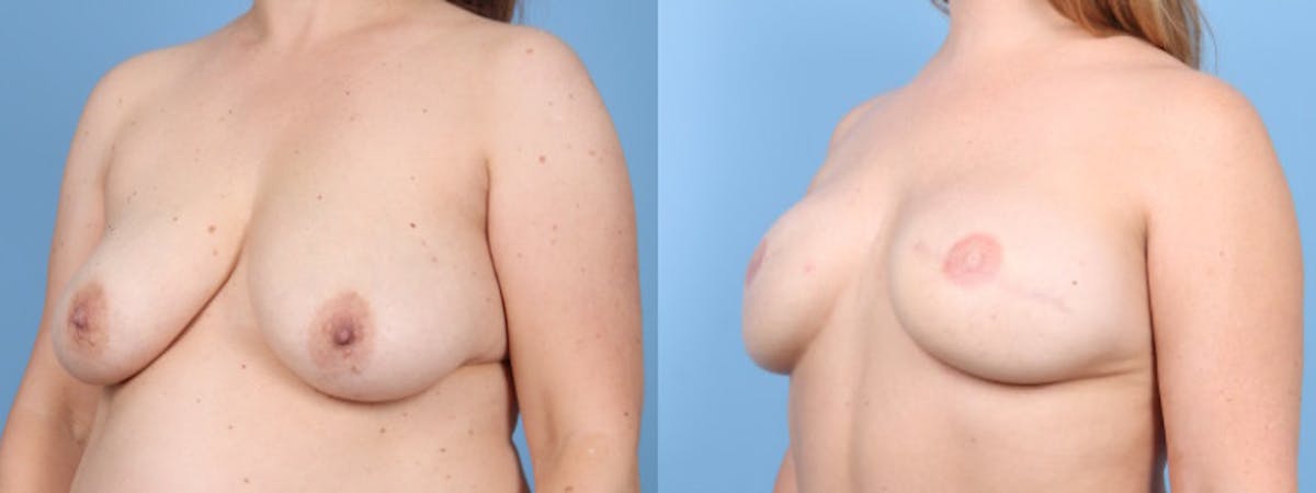 3D Nipple Tattoo Before & After Gallery - Patient 222592 - Image 2