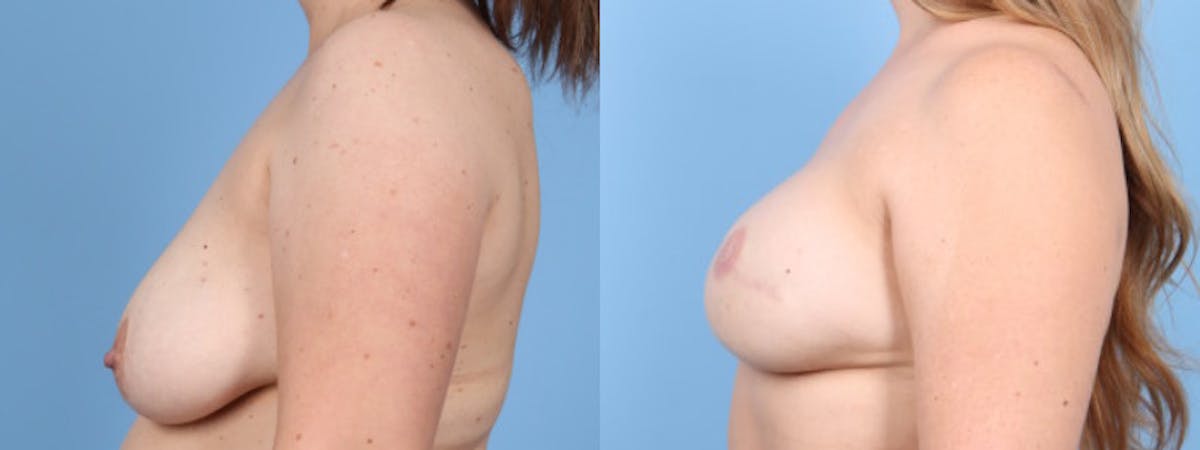 3D Nipple Tattoo Before & After Gallery - Patient 222592 - Image 5