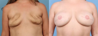 3D Nipple Tattoo Before & After Gallery - Patient 730589 - Image 1
