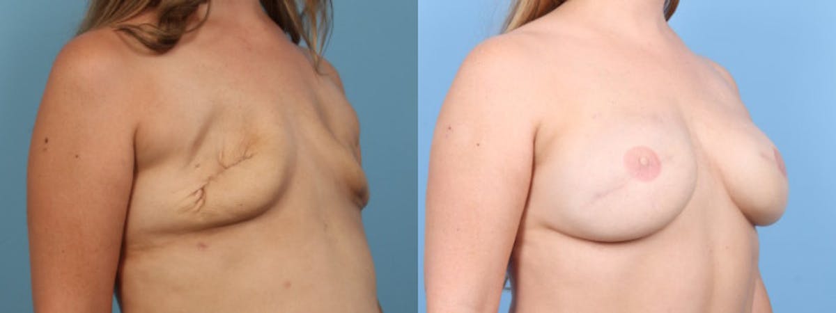3D Nipple Tattoo Before & After Gallery - Patient 730589 - Image 2