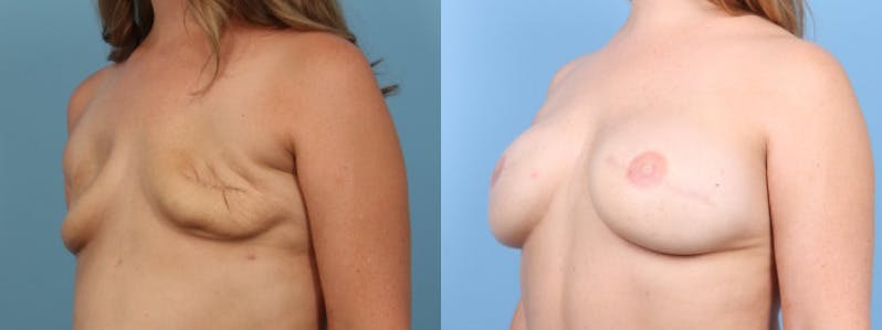 3D Nipple Tattoo Before & After Gallery - Patient 730589 - Image 3