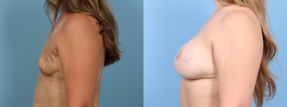 3D Nipple Tattoo Before & After Gallery - Patient 730589 - Image 4
