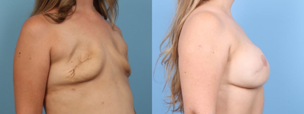 3D Nipple Tattoo Before & After Gallery - Patient 730589 - Image 5