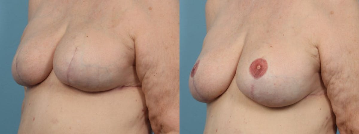 3D Nipple Tattoo Before & After Gallery - Patient 208092 - Image 2
