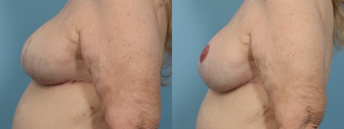 3D Nipple Tattoo Before & After Gallery - Patient 208092 - Image 3