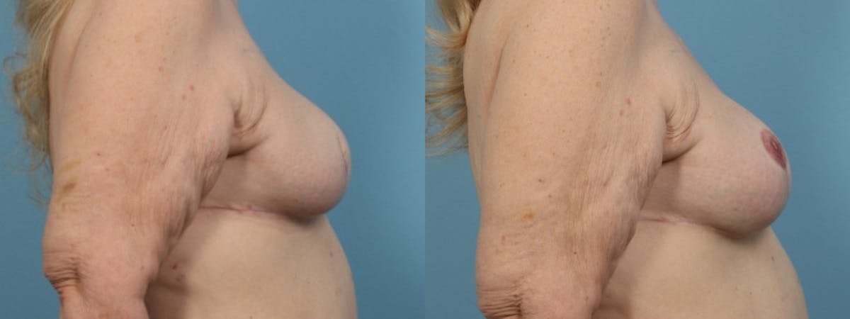 3D Nipple Tattoo Before & After Gallery - Patient 208092 - Image 4