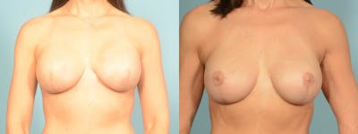 3D Nipple Tattoo Before & After Gallery - Patient 325008 - Image 1