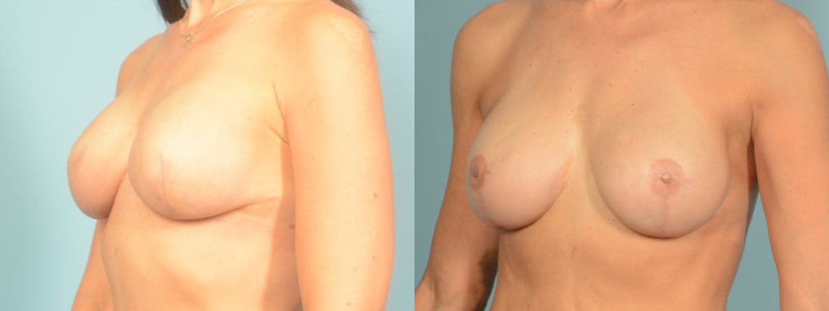 3D Nipple Tattoo Before & After Gallery - Patient 325008 - Image 2