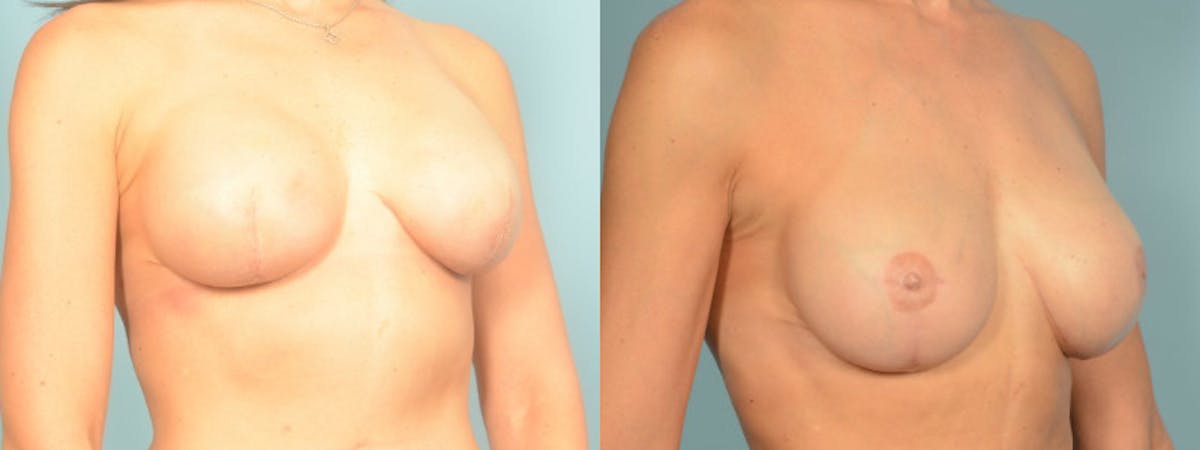 3D Nipple Tattoo Before & After Gallery - Patient 325008 - Image 3
