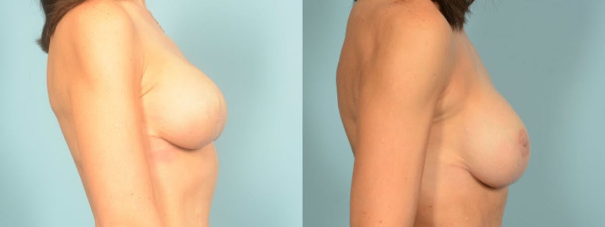 3D Nipple Tattoo Before & After Gallery - Patient 325008 - Image 4