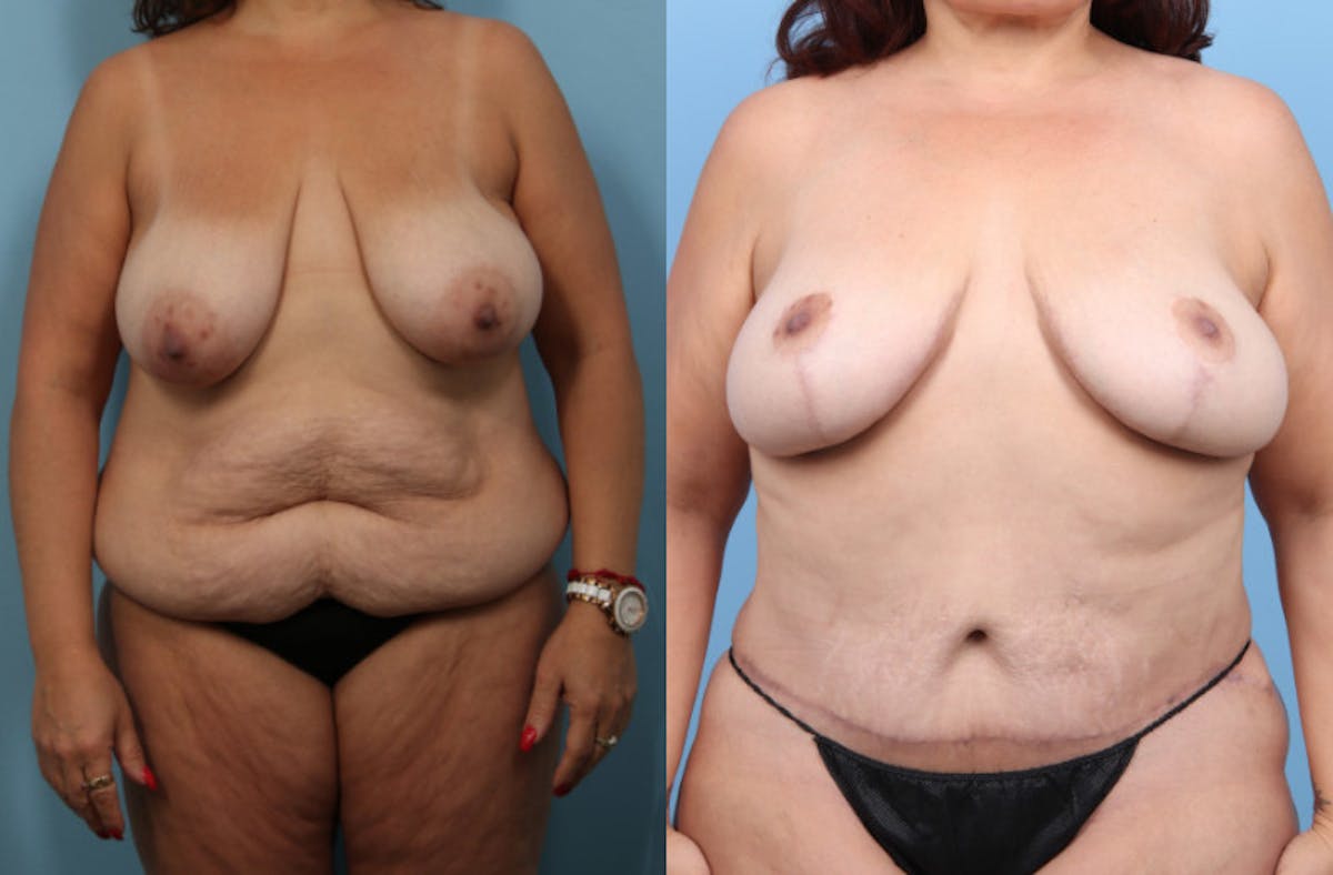 Tummy Tuck Before & After Gallery - Patient 320120 - Image 1