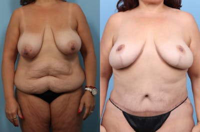Tummy Tuck Before & After Gallery - Patient 320120 - Image 1