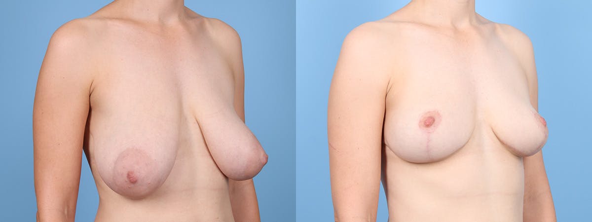 Breast Reduction/Lift Before & After Gallery - Patient 224292 - Image 2
