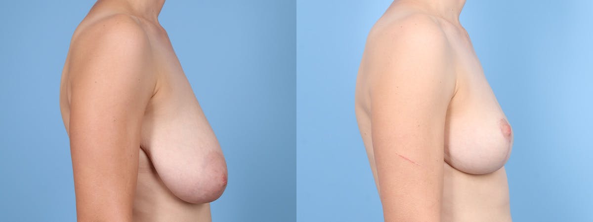 Breast Reduction/Lift Before & After Gallery - Patient 224292 - Image 3