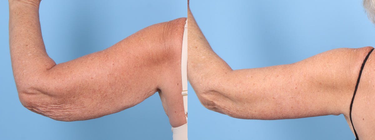 Arm Lift (Brachioplasty) Before & After Gallery - Patient 413341 - Image 1