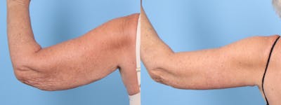 Arm Lift (Brachioplasty) Before & After Gallery - Patient 413341 - Image 1