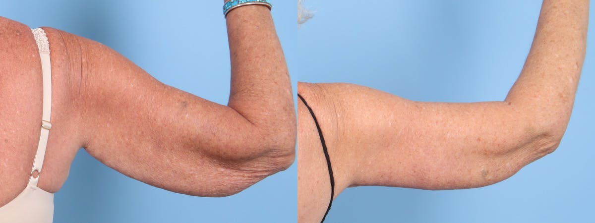Arm Lift (Brachioplasty) Before & After Gallery - Patient 413341 - Image 2