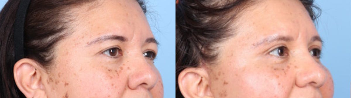 Eyelid Surgery Before & After Gallery - Patient 368566 - Image 2