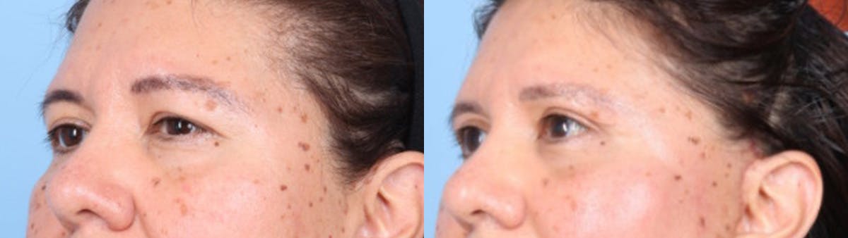 Eyelid Surgery Before & After Gallery - Patient 368566 - Image 4