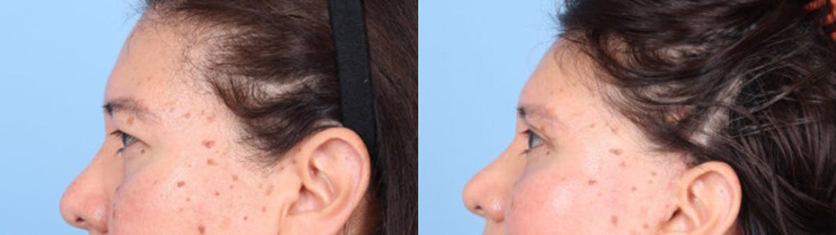 Eyelid Surgery Before & After Gallery - Patient 368566 - Image 5