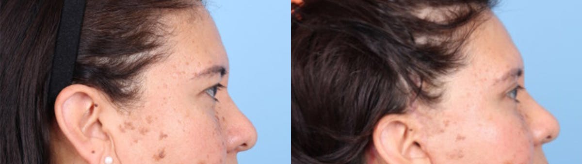 Eyelid Surgery Before & After Gallery - Patient 368566 - Image 3