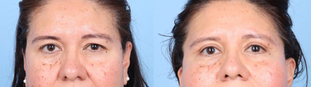 Eyelid Surgery Before & After Gallery - Patient 368566 - Image 1
