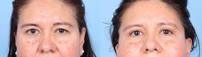 Eyelid Surgery Before & After Gallery - Patient 368566 - Image 1