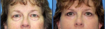 Eyelid Surgery Before & After Gallery - Patient 207642 - Image 1