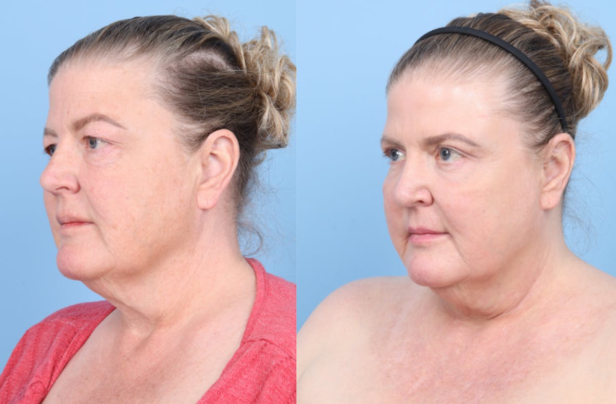 CO2 Laser Before & After Gallery - Patient 112908 - Image 2