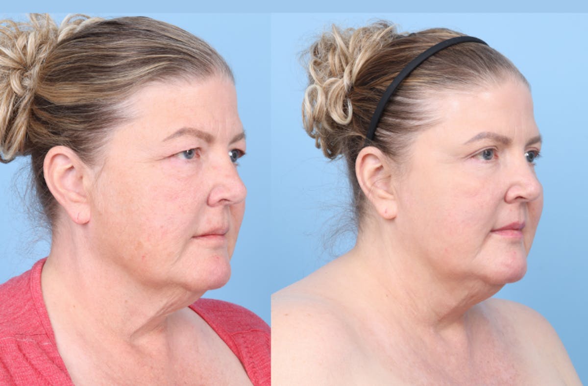 CO2 Laser Before & After Gallery - Patient 112908 - Image 3