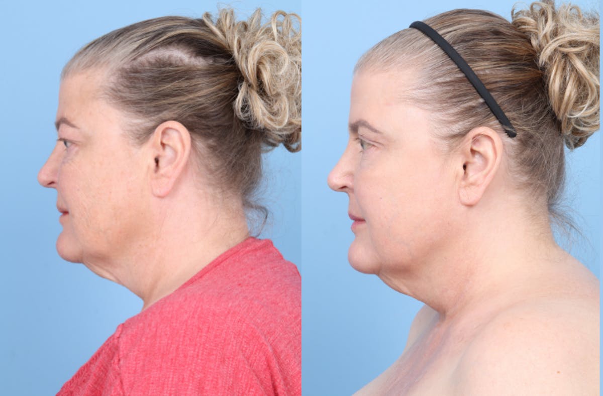 CO2 Laser Before & After Gallery - Patient 112908 - Image 5