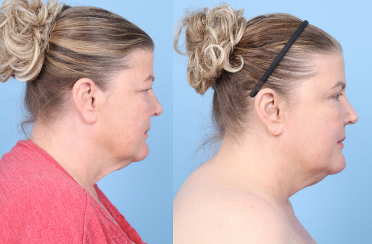 CO2 Laser Before & After Gallery - Patient 112908 - Image 4