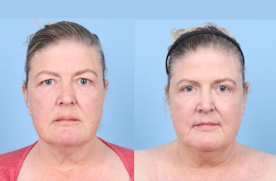 CO2 Laser Before & After Gallery - Patient 112908 - Image 1