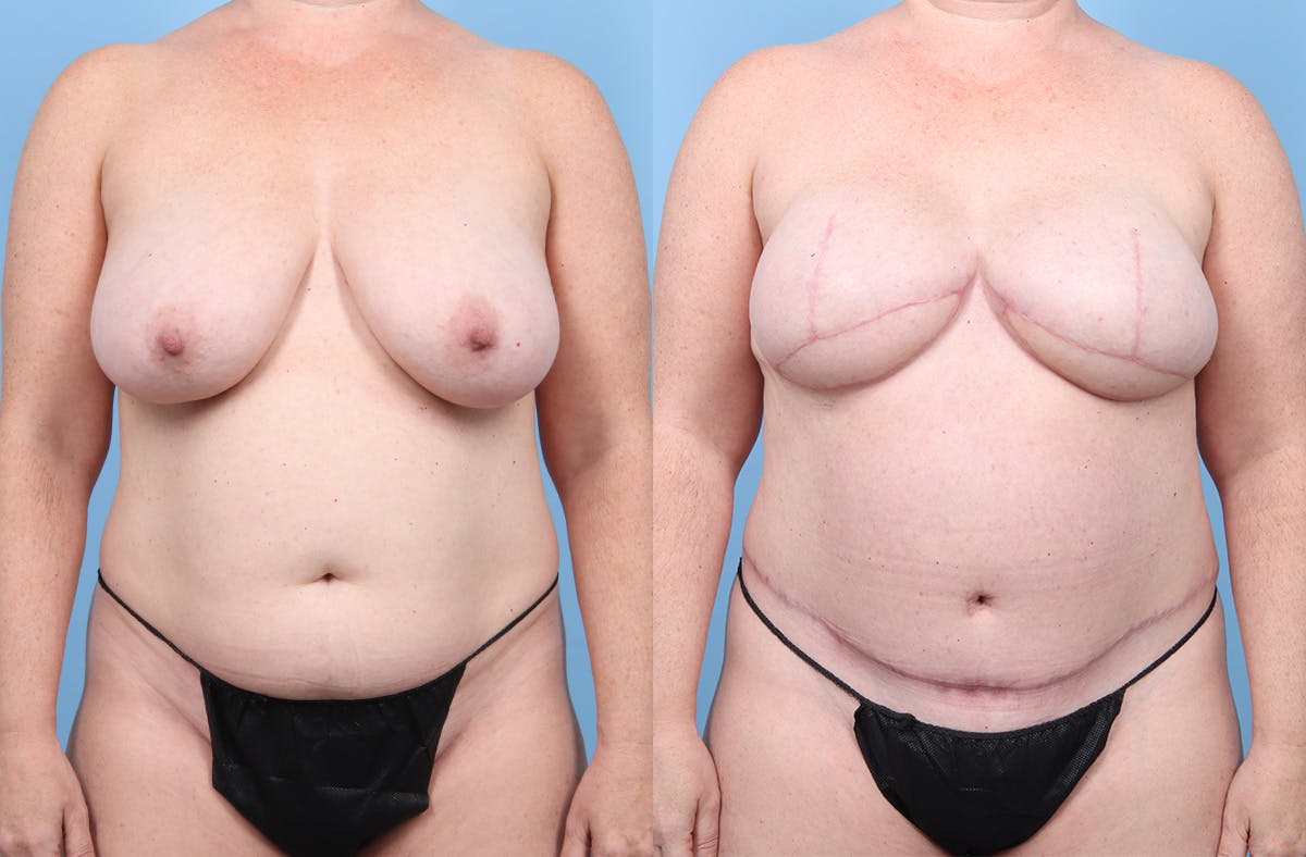 DIEP Flap Reconstruction Before & After Gallery - Patient 405285 - Image 1