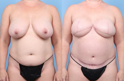 DIEP Flap Reconstruction Before & After Gallery - Patient 405285 - Image 1