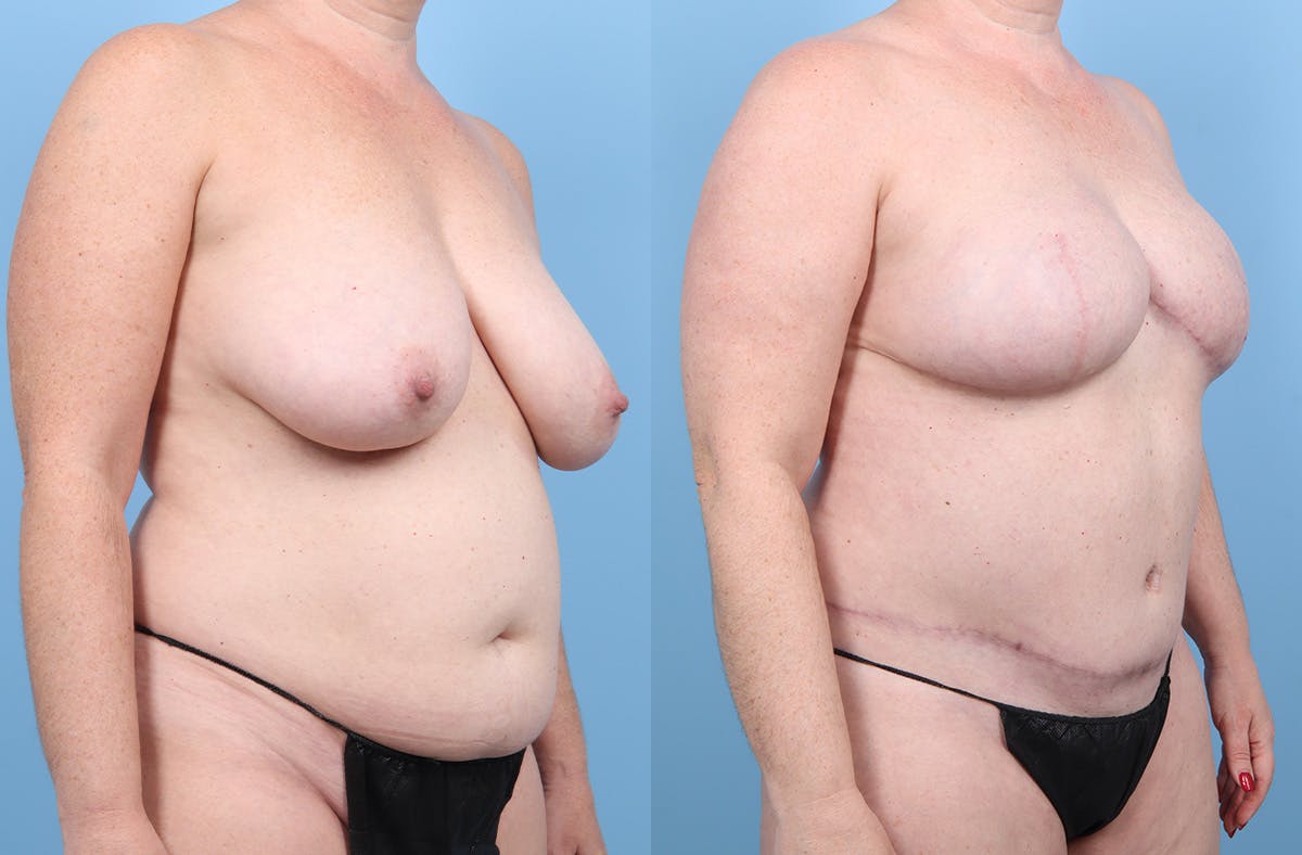 DIEP Flap Reconstruction Before & After Gallery - Patient 405285 - Image 2
