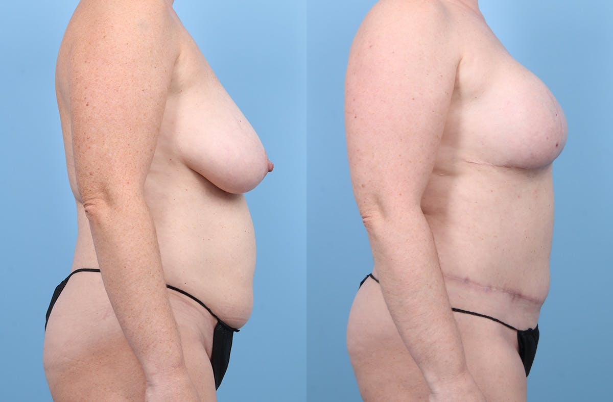 DIEP Flap Reconstruction Before & After Gallery - Patient 405285 - Image 3
