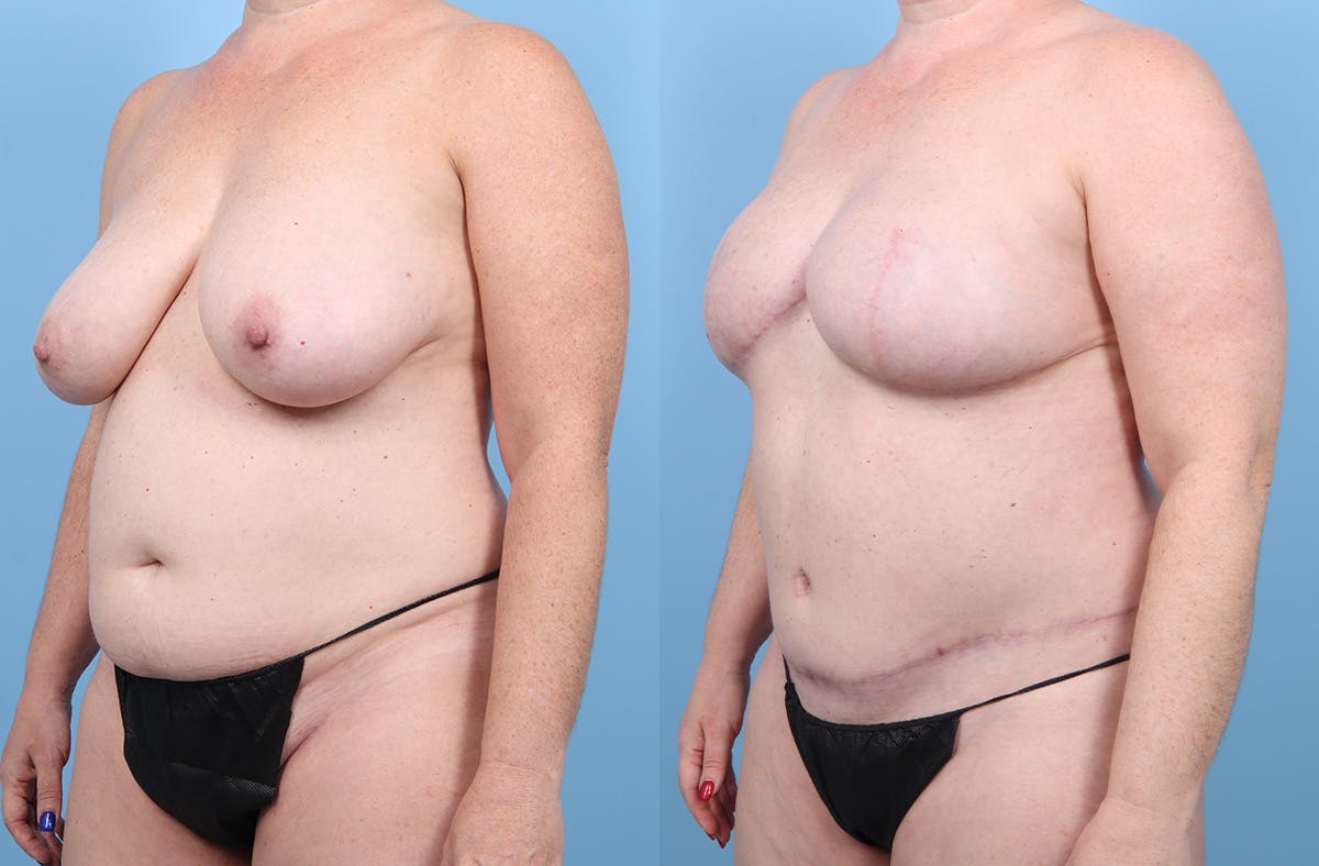 DIEP Flap Reconstruction Before & After Gallery - Patient 405285 - Image 4
