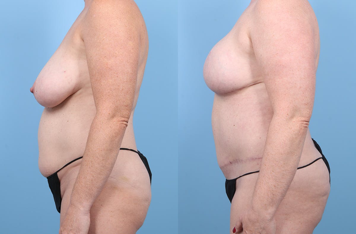 DIEP Flap Reconstruction Before & After Gallery - Patient 405285 - Image 5
