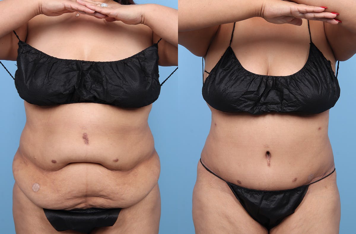 Tummy Tuck Before & After Gallery - Patient 135096 - Image 1
