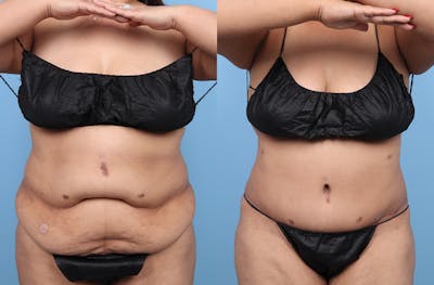 Tummy Tuck Before & After Gallery - Patient 135096 - Image 1