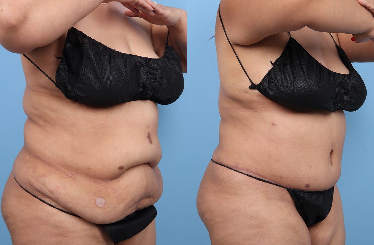 Tummy Tuck Before & After Gallery - Patient 135096 - Image 2