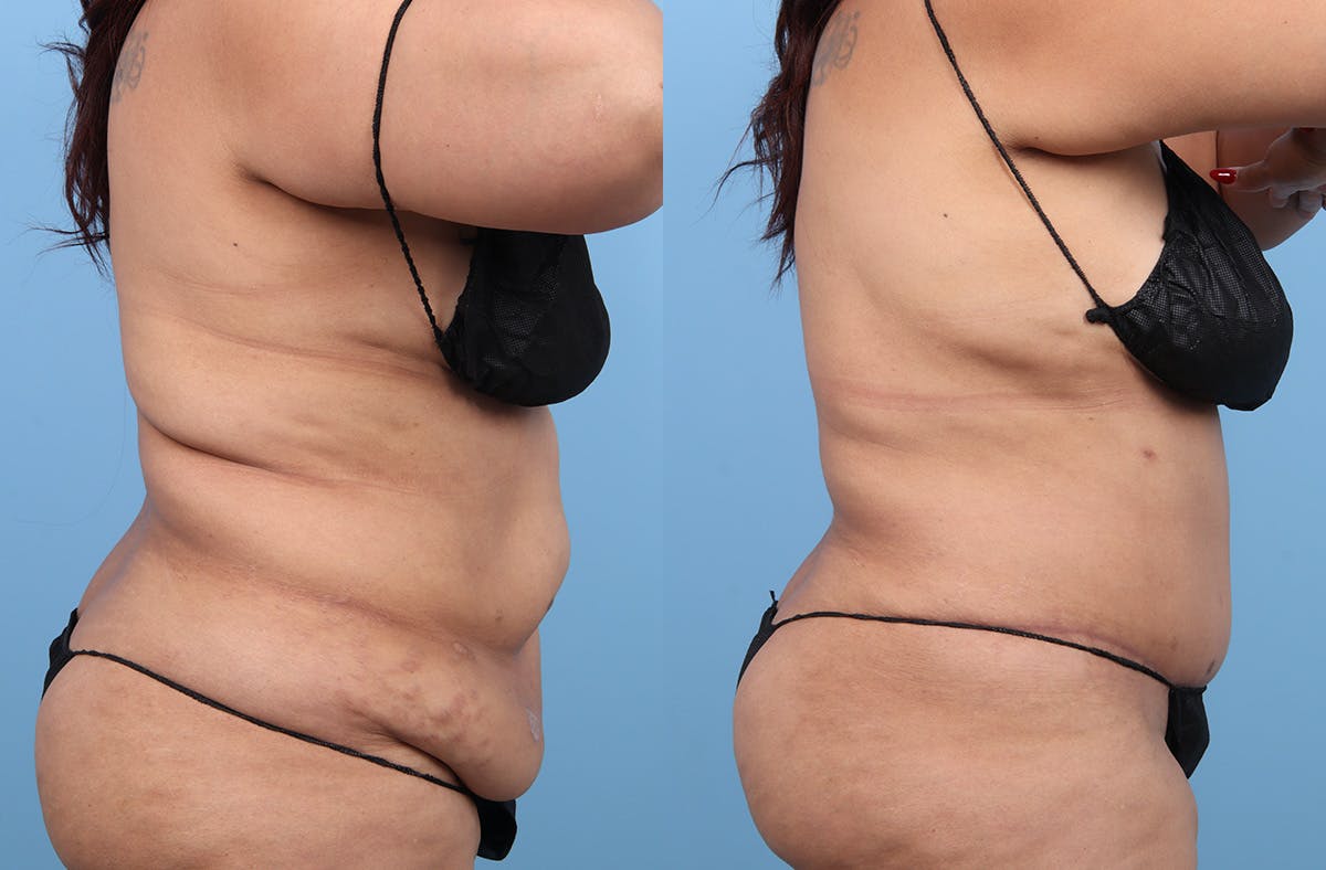 Tummy Tuck Before & After Gallery - Patient 135096 - Image 3