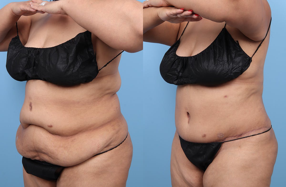 Tummy Tuck Before & After Gallery - Patient 135096 - Image 4