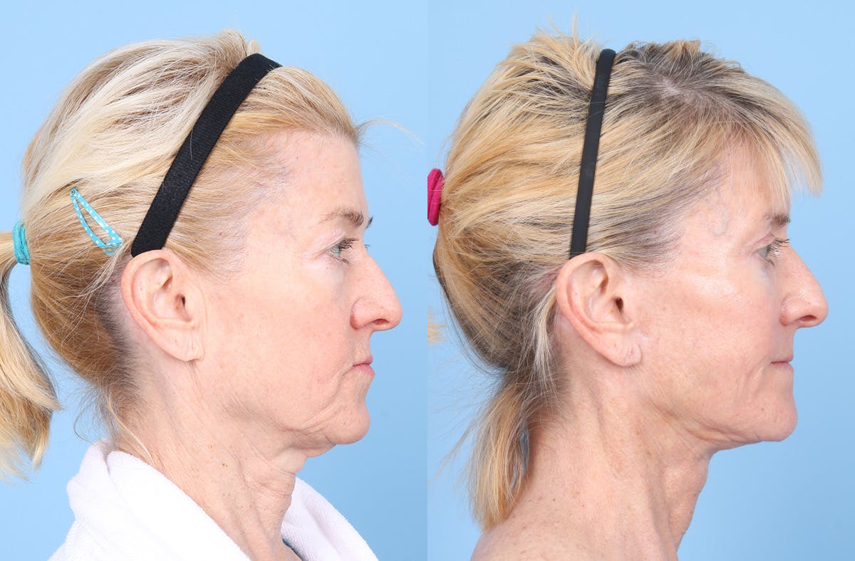 Neck Lift Before & After Gallery - Patient 842296 - Image 5
